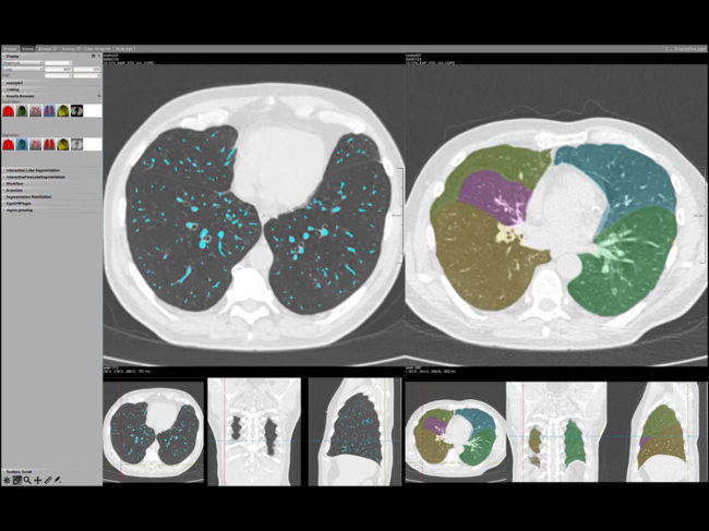 Software screenshot of chest CT imaging analysis 