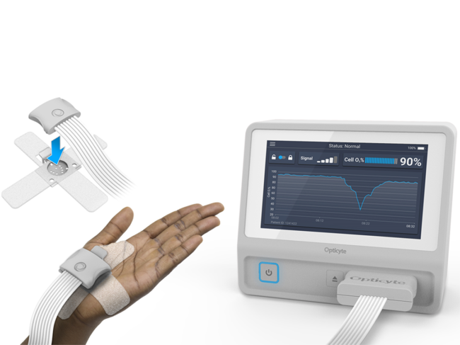 FDA clears Sotera's continuous blood pressure monitor