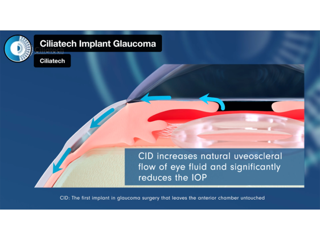 Ciliatech Implant Glaucoma