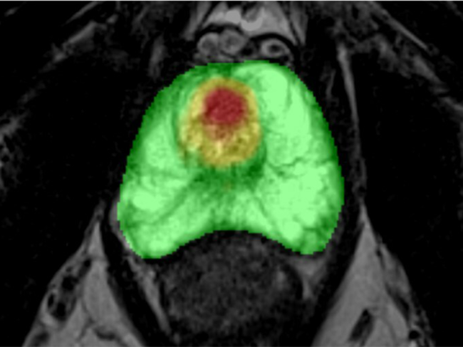 Enhanced MRI imaging using Prostatid.