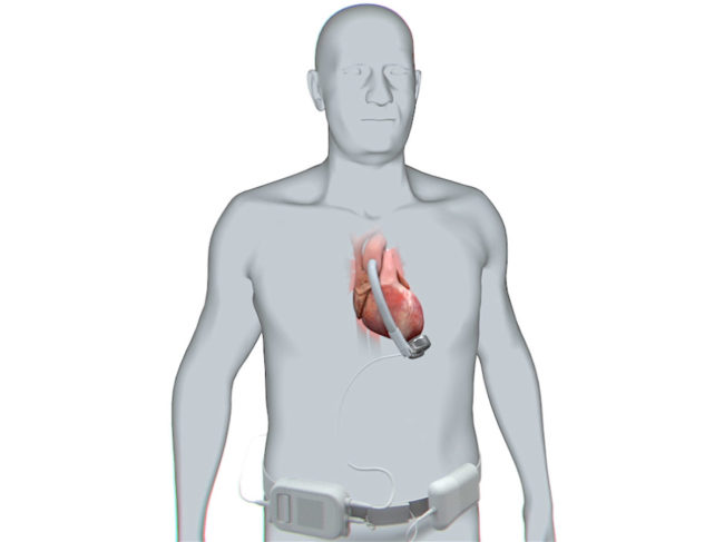 Corwave LVAD system on patient