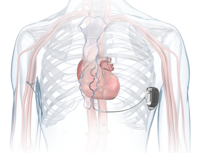 Illustration of Aurora EV-ICD in chest
