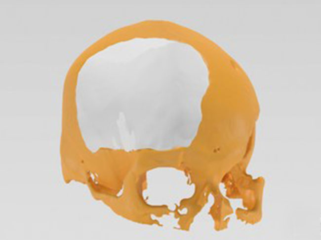 Osteopore 3D skull implant