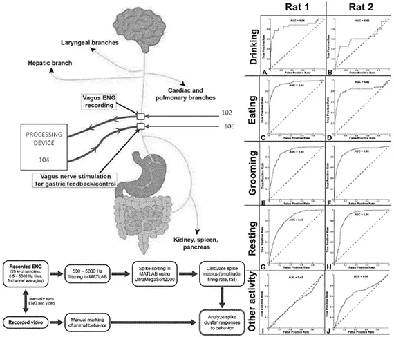 vagus nerve stimulation for weight loss
