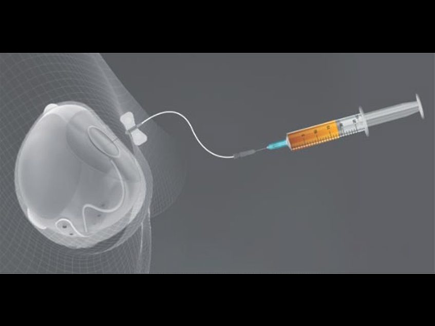 Sientra wins FDA clearance for next generation Allox2 Pro tissue