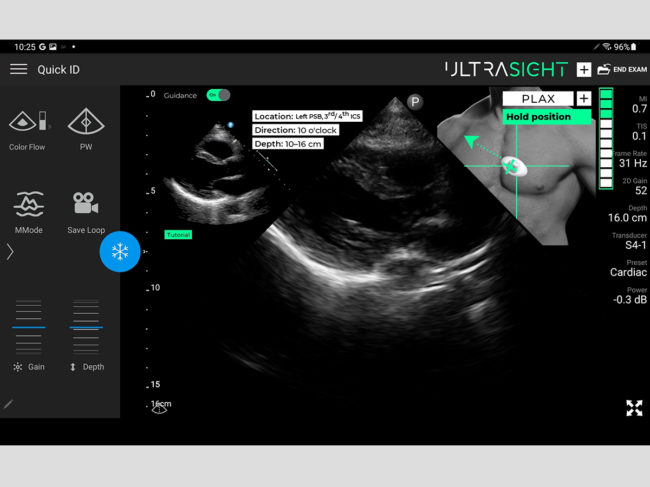 UltraSight AI ultrasound guidance software
