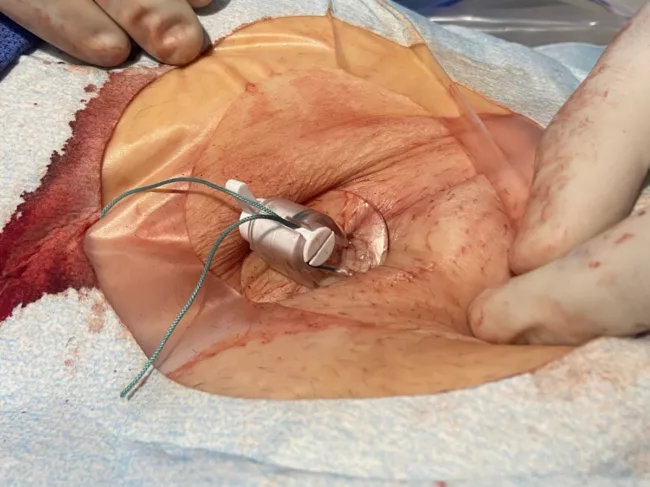 Locket device placed after surgery