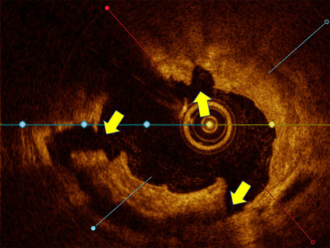 Intravascular image optical coherence tomography showing large cracks in plaque