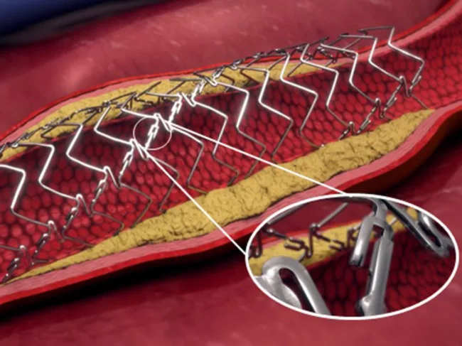 Dynamx coronary bioadaptor system