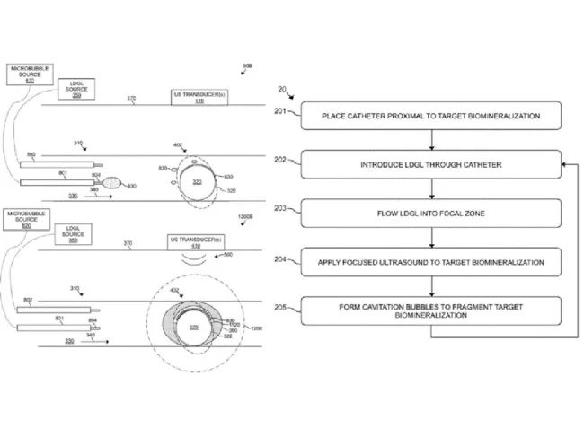 acoustic enhancer tech