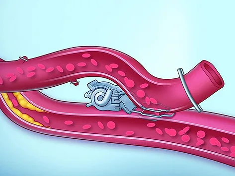 Amt medical elana heart bypass system 24apr25