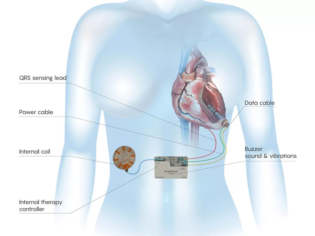 Fineheart pursues FIH study of Flowmaker fully implanted heart pump |  BioWorld