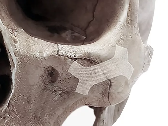 Cohesys Bonetape aims to reconstruct facial surgery | BioWorld