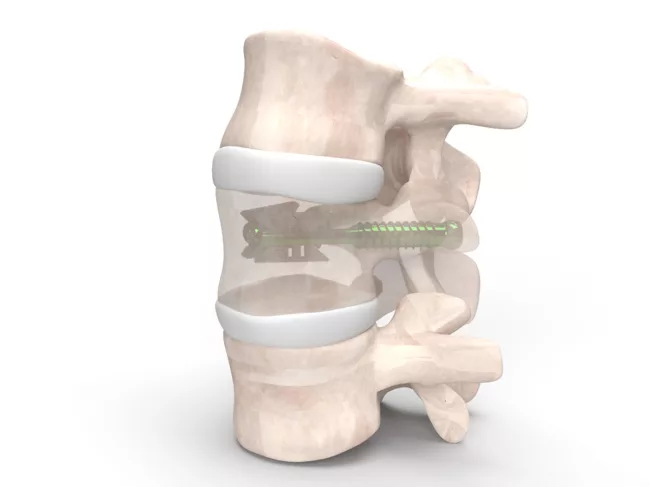 Amber Implants VCFix Spinal System
