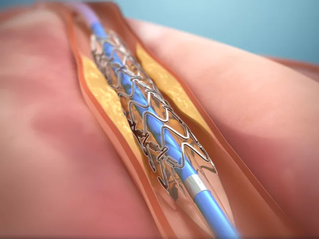 Elixir Medical DynamX