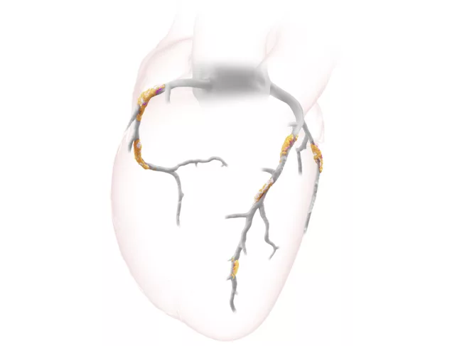 Heartflow illustration 