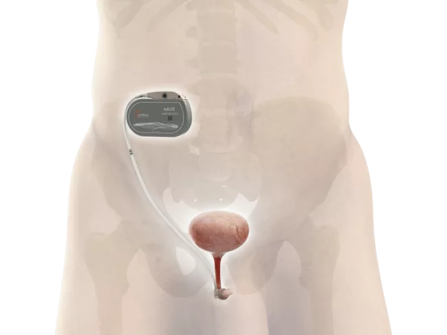 Uroactive smart implant