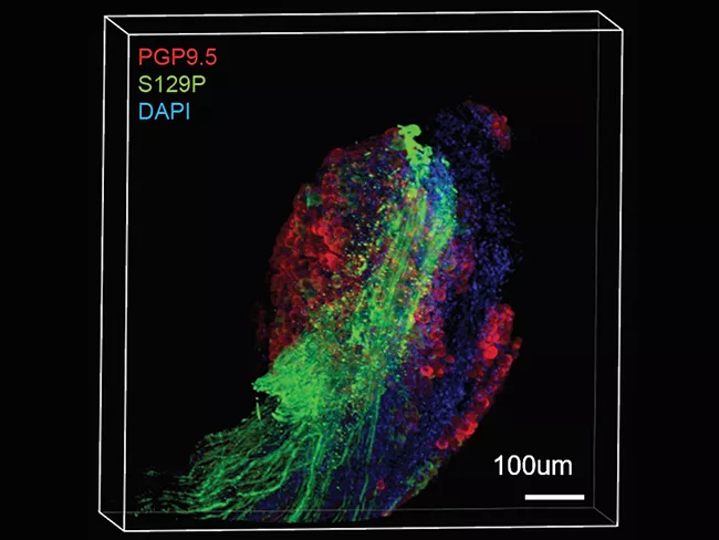 Progression of alpha-synuclein pathology