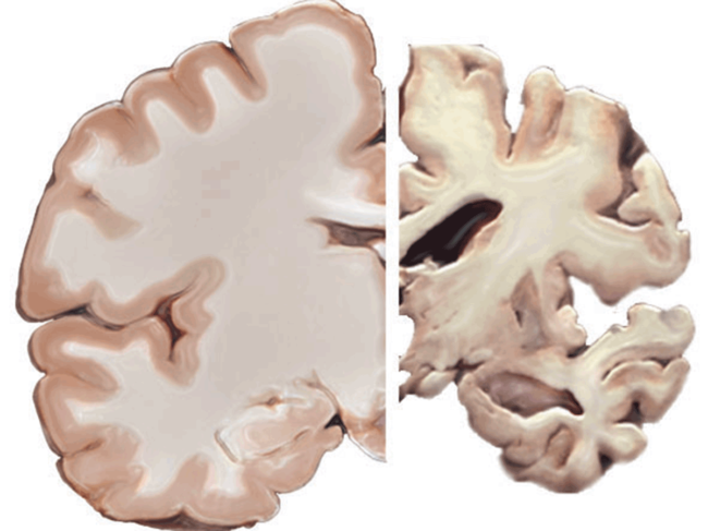 Healthy brain and brain with severe Alzheimer's disease