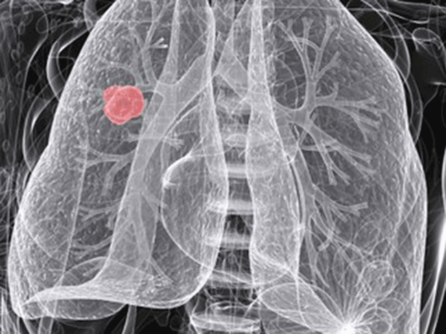 Non-small-cell lung cancer
