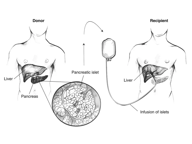 Islet transplantation