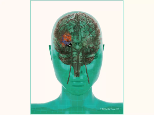 Clinuvel stroke illustration