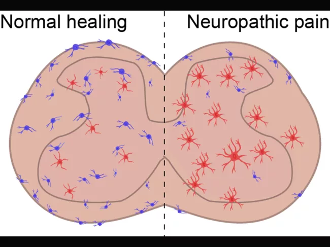 Neuropathic pain