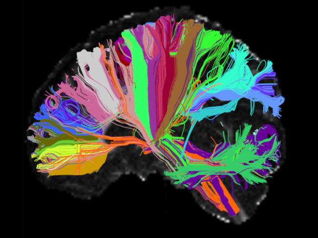 Tract mapping in the human brain