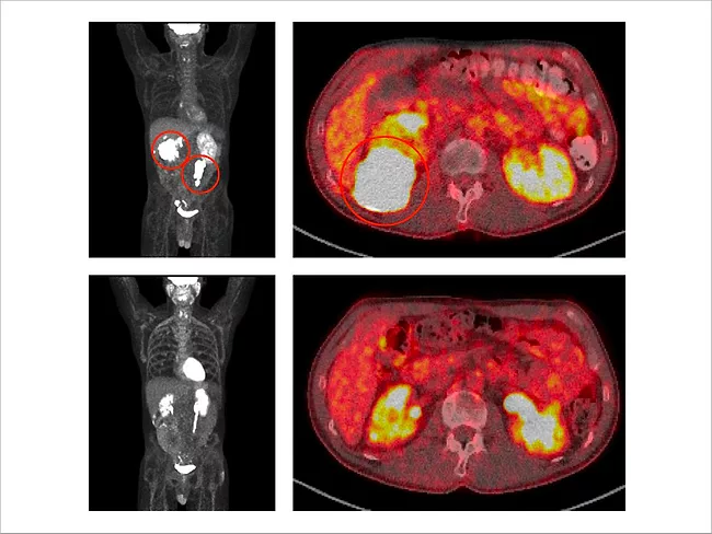 PET scans showing before and after treatment with VIPOR