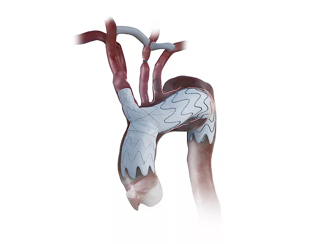 Nexus aortic arch stent graft