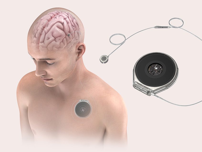 Paradromics partners with academics to accelerate BCI development