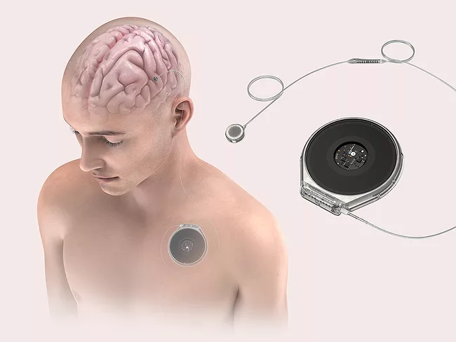 Paradromicx Connexus BCI