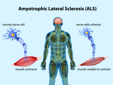 Illustration demonstrating muscle contraction in amyotrophic lateral sclerosis.