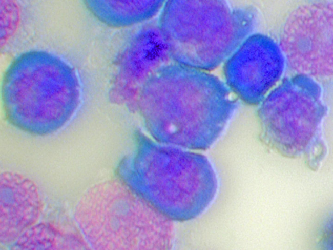 Microscopic image of acute myeloid leukemia (AML) cells.