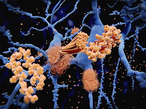 Amyloid beta peptides on neurons