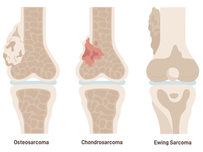 Illustration of bones showing difference in Ewing sarcoma, osteosarcoma and chondrosarcoma
