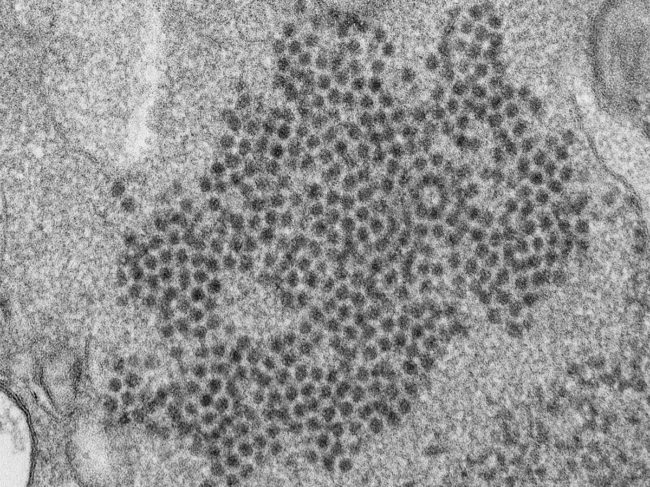 Transmission electron microscopic image of numerous Enterovirus-D68 (EV-D68) virions