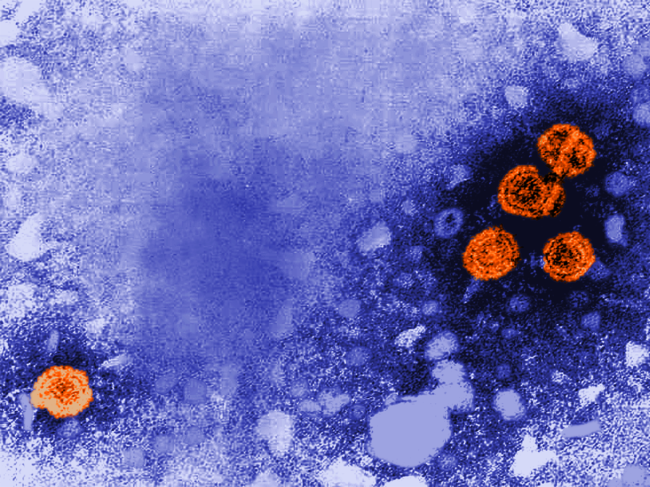 Transmission electron microscopic image of hepatitis B virus. 