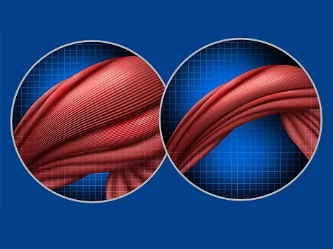 Illustration of normal muscle compared to muscle atrophy in cancer cachexia or anorexia