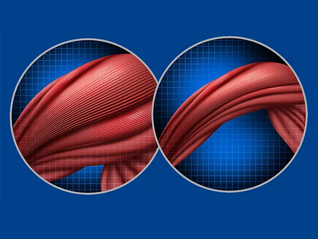 Illustration of normal muscle compared to muscle atrophy in cancer cachexia or anorexia