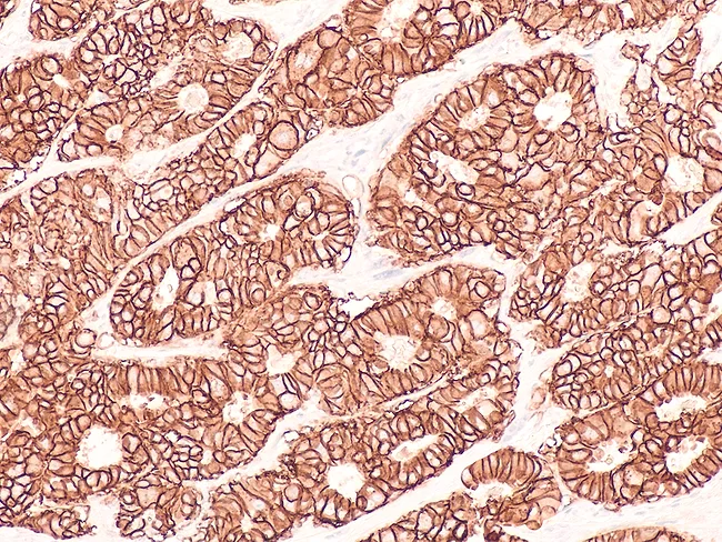 Photomicrograph of immunohistochemistry for HER2