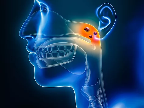 Illustration of nasopharyngeal carcinoma
