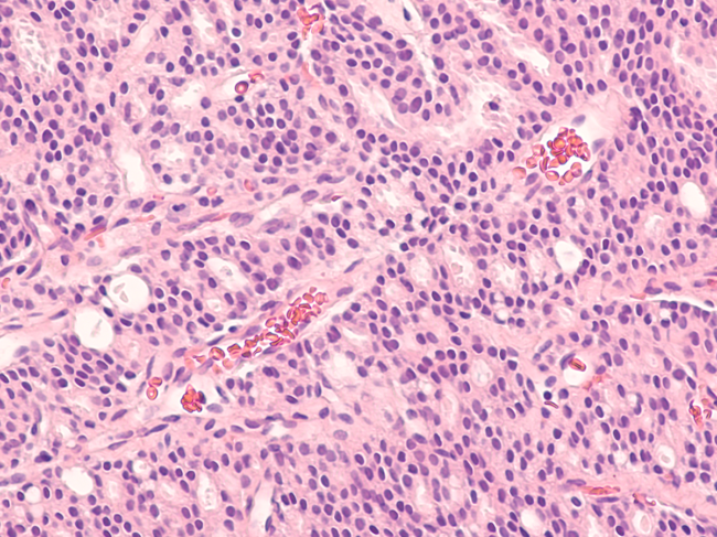 Photomicrograph of core biopsy of prostate gland showing histology of adenocarcinoma in patient with elevated PSA.