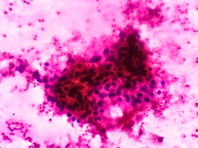 Microscopic image of clear cell carcinoma, the most common type of renal cell carcinoma.