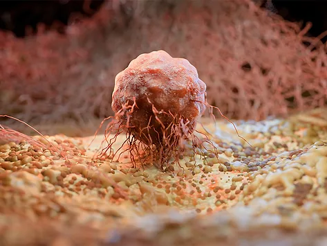 Illustration of a tumor