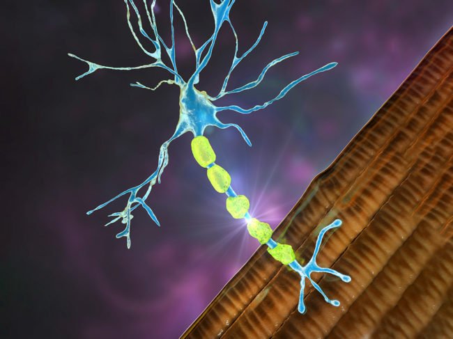 Demyelination of a neuron