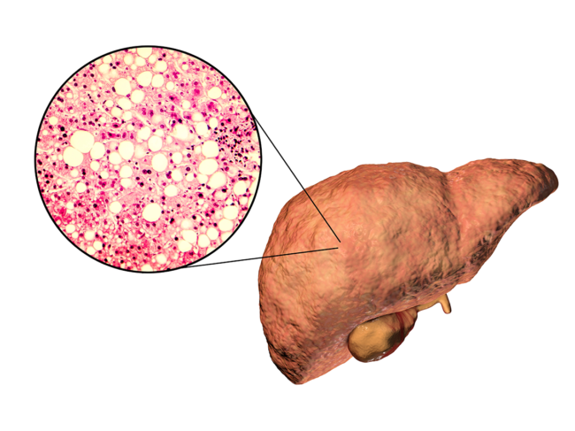 3D illustration of liver and photomicrograph showing triglyceride fat accumulated in liver cells.