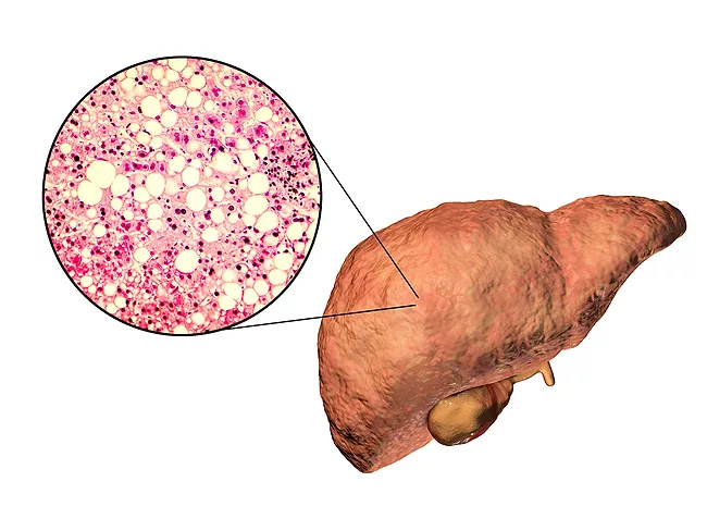 3D illustration of liver and photomicrograph showing triglyceride fat accumulated in liver cells.