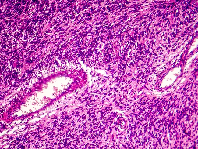 Light micrograph of fibrosarcoma, a type of soft tissue sarcoma