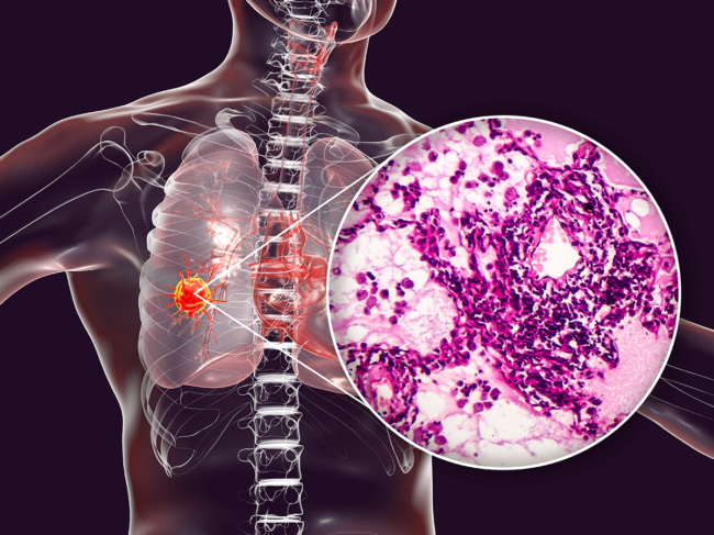 3D illustration and light micrograph of lung cancer.